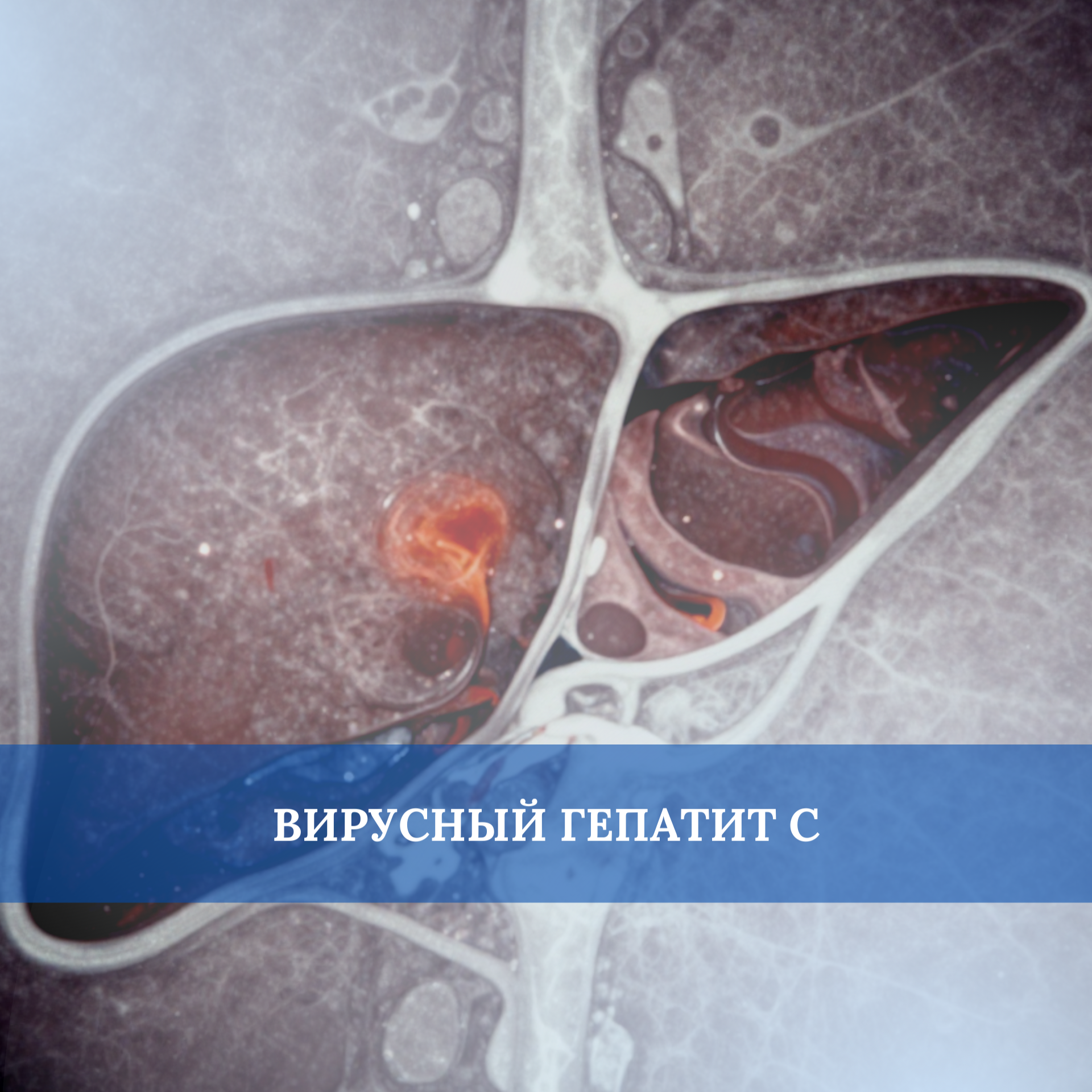 Вирусный гепатит С